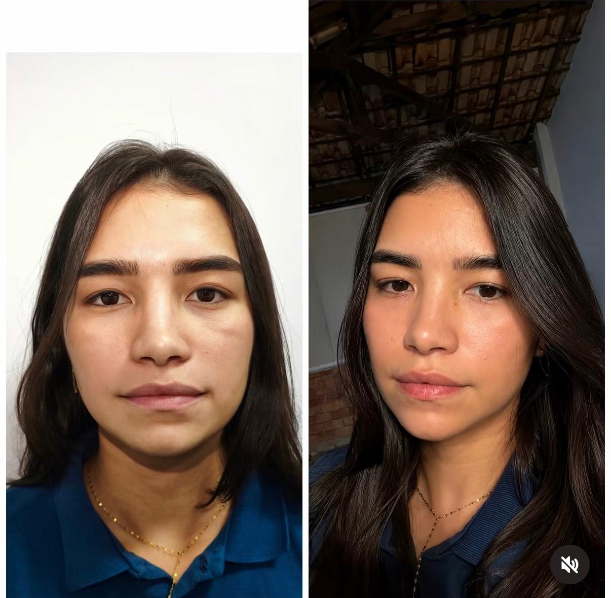Antes e depois de procedimento realizado pela Dra. Gianni