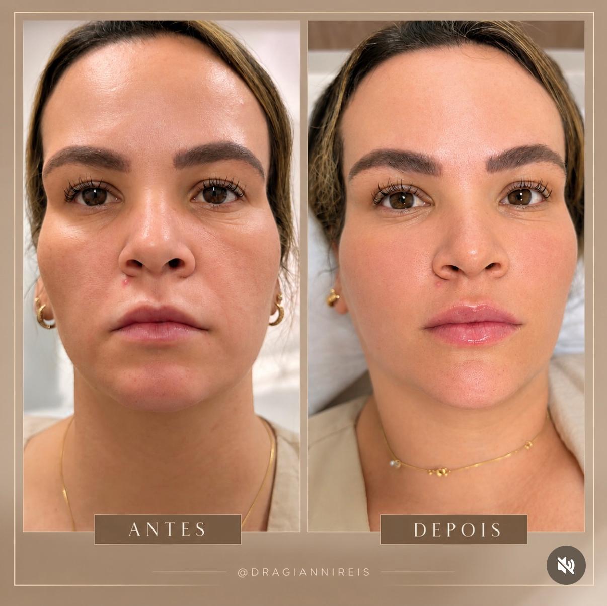 Antes e depois de procedimento realizado pela Dra. Gianni