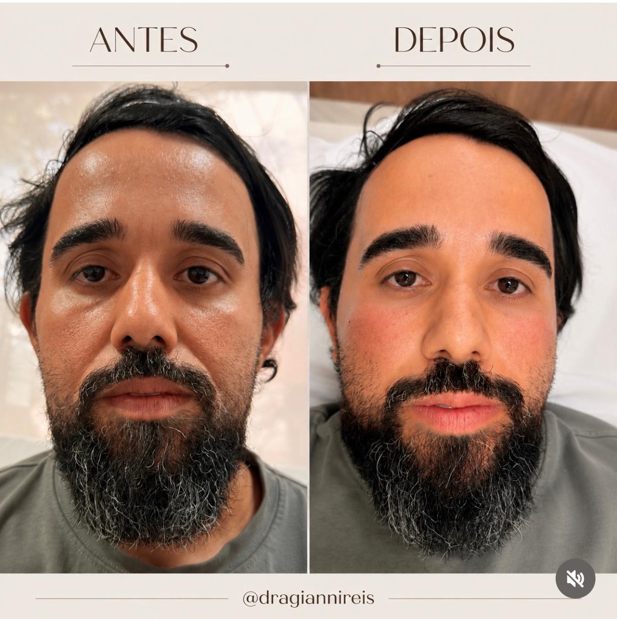 Antes e depois de procedimento realizado pela Dra. Gianni