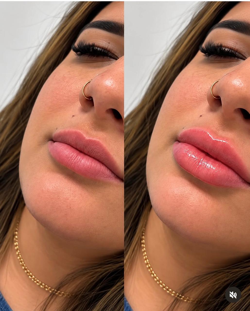 Antes e depois de procedimento realizado pela Dra. Gianni